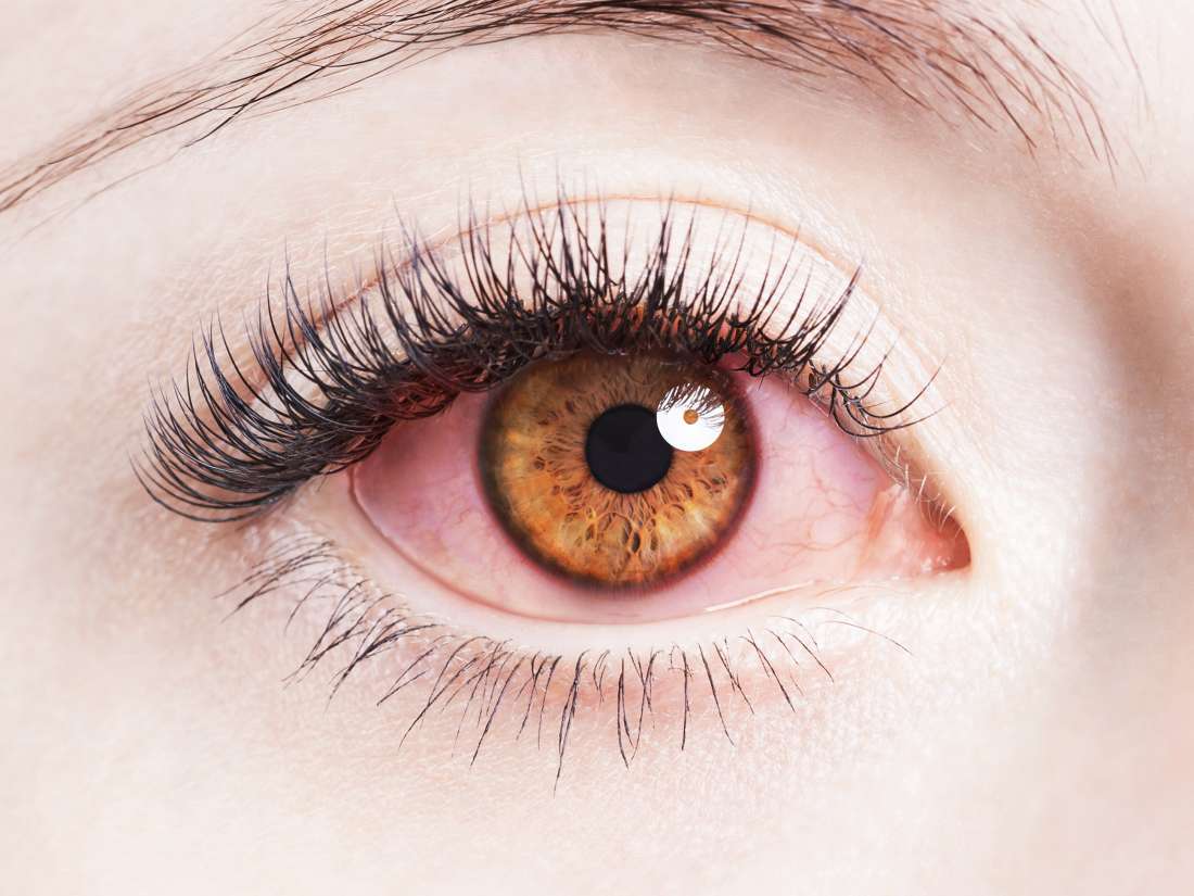 Stressed Out Eyes - Colored Contact Lenses