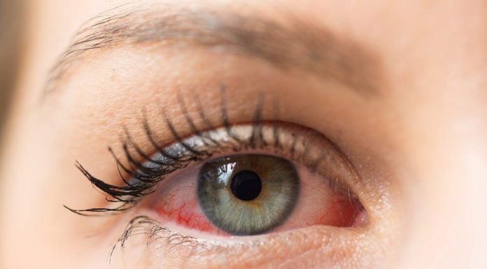 5 Common Symptoms Of Infections For Which You Need An Eye Test Swollen Eyes