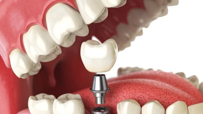 Know The Amazing Advantages of Dental Implants Treatment Dental Implants Treatment