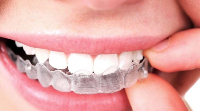 Invisalign: Teeth Straightening For Adults Invisalign Devices Are Removable