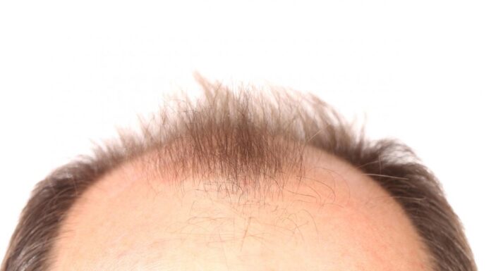 Does Creatine Cause Baldness? Creatine Causes Baldness