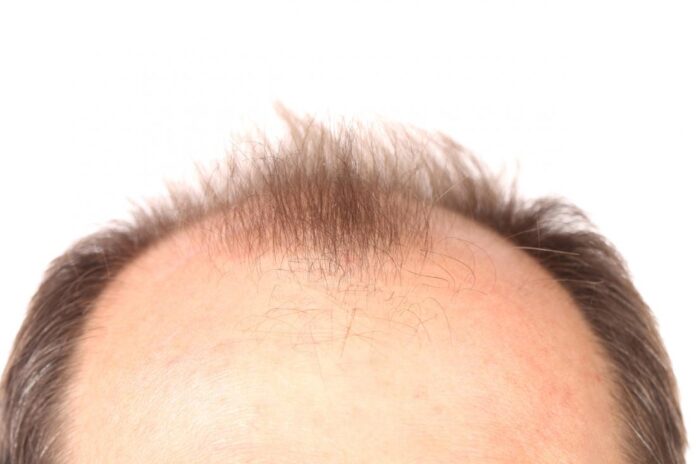 Creatine Causes Baldness