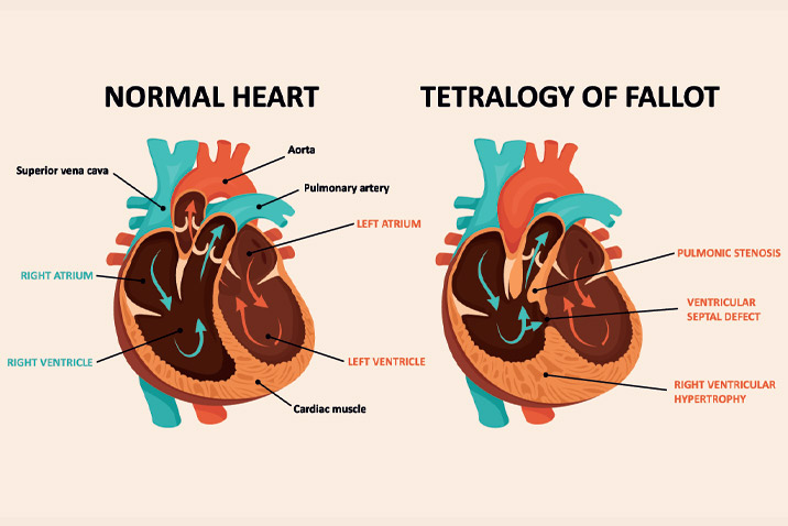 Congenital Heart Disease - Tetralogy Fallot