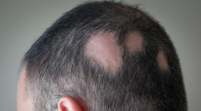 What You Should Know About Alopecia Areata? Alopecia Areata