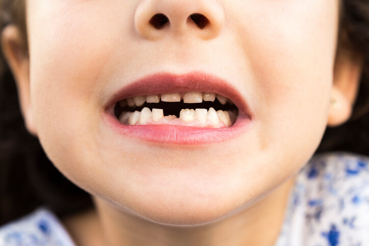 Misalignment in Teeth