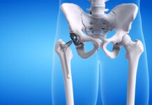 8 Proven Strategies for Quick Recovery After Hip Replacement Surgery Hip Replacement