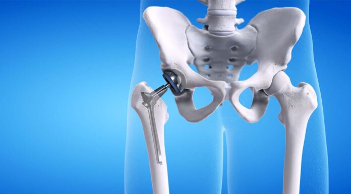 8 Proven Strategies for Quick Recovery After Hip Replacement Surgery Hip Replacement