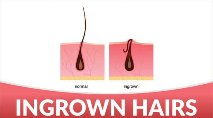 Ingrown Hairs – Causes, Prevention and Treatment Ingrown Hairs Treatment