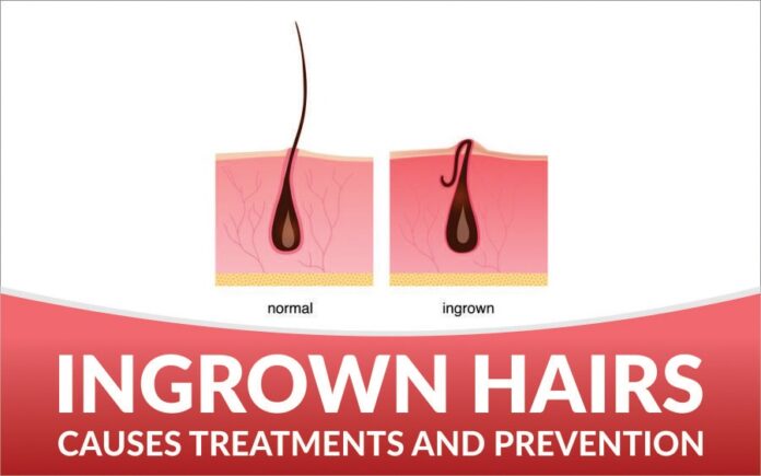 Ingrown Hairs Treatment