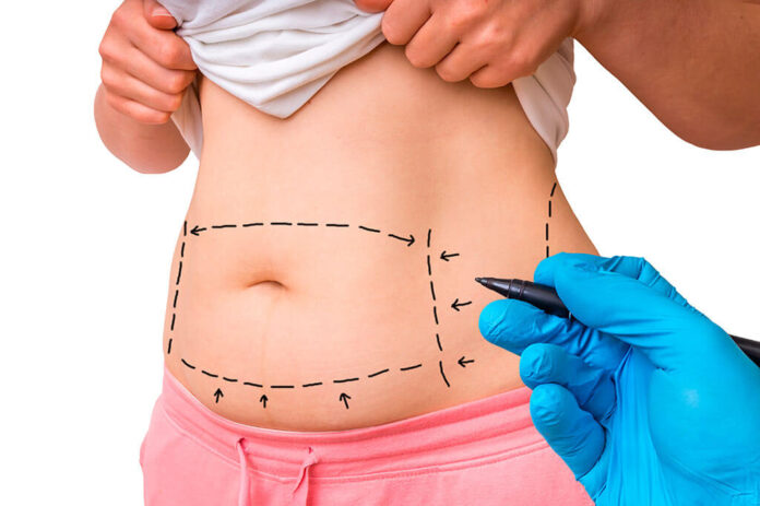 Liposuction Treatment